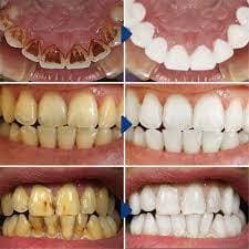 Teeth Whitening Foam To Remove Tartar thumbnail 2