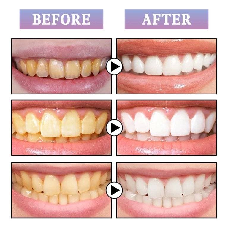 Teeth Whitening Foam To Remove Tartar thumbnail 4